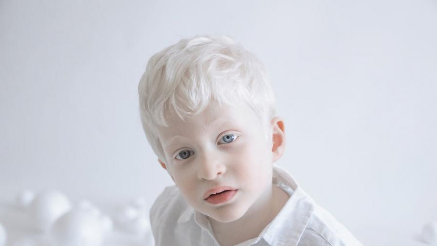 Великолепни албиноси - генна мутация, която те прави сякаш вълшебен -  Любопитно | Vesti.bg