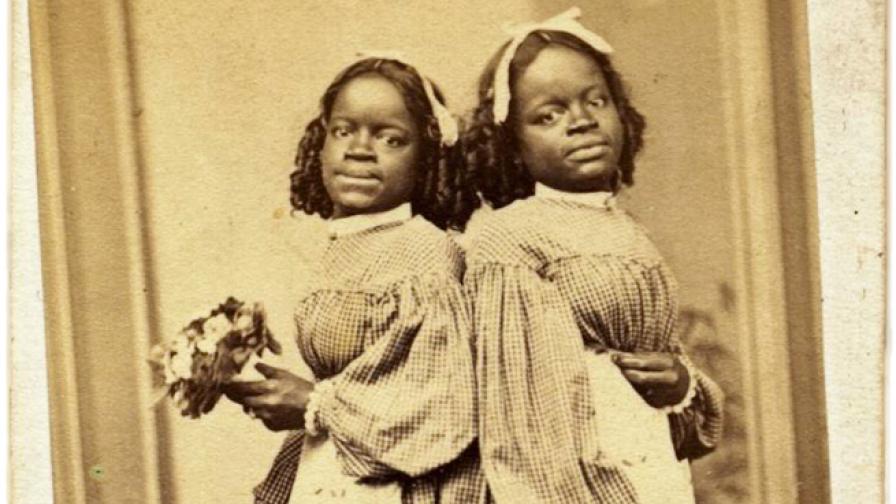 Историята на "Двуглавото момиче", родено в робство