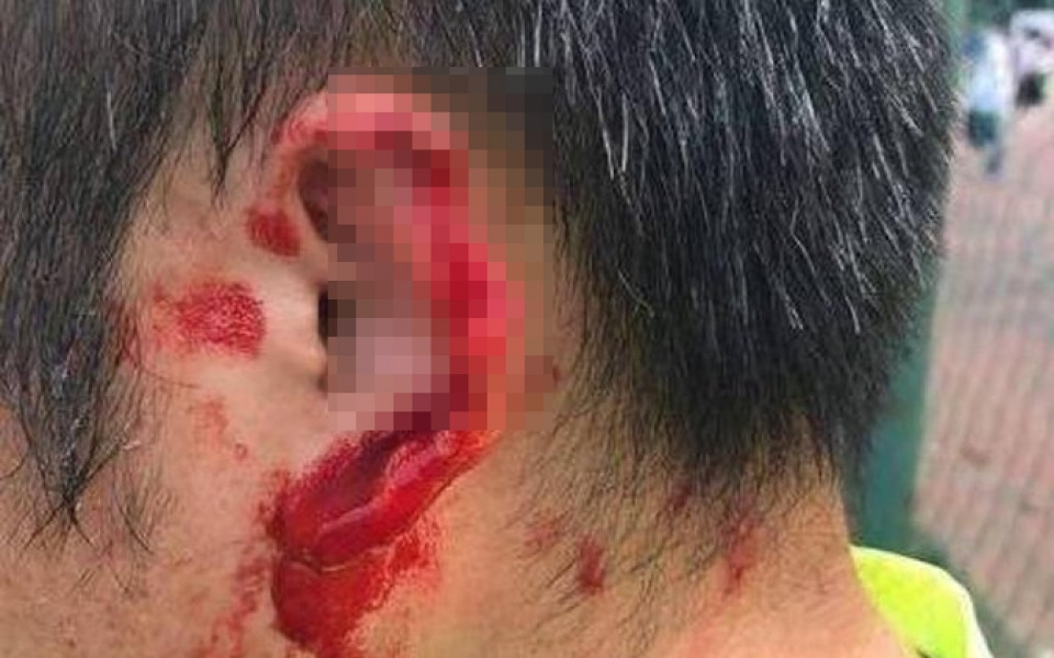Отхапаха ухото на футболист след зверски бой в Китай (+18)