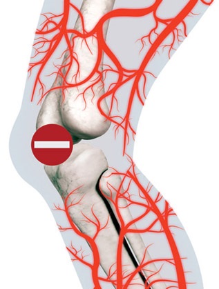 Кръвоносните съдове не навлизат в ставния хрущял, което възпрепятства неговото изхранване чрез кръвта