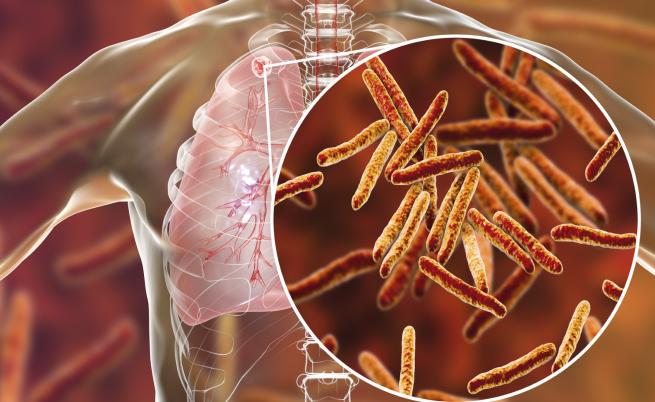 Как лаборатория откри туберкулоза при здрава жена