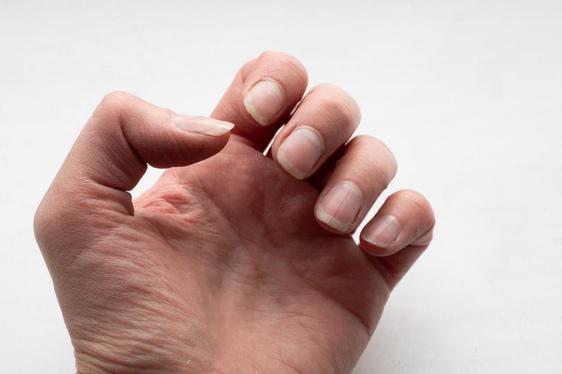 <p><strong>Бледи нокти</strong></p>

<p>Много бледите нокти понякога могат да бъдат признак на сериозно заболяване, като анемия, застойна сърдечна недостатъчност, чернодробно заболяване или недохранване.</p>