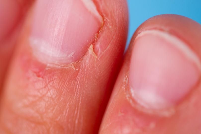 <p><strong>Подпухнали нокътни гънки</strong></p>

<p>Ако кожата около нокътя (&quot;кожичките&quot;) изглежда червена и подпухнала, вероятно става въпрос за възпаление на нокътната гънка. Част е и от симптомите на лупус и други разстройства на съединителната тъкан. Различни инфекции също могат да причинят зачервяване и възпаление на нокътната гънка.</p>