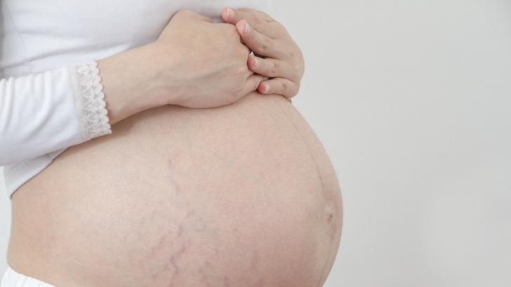 Стрии по време на бременност - всичко, което трябва да знаете
