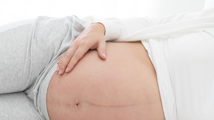 Linea Nigra: всичко, което трябва да знаете за линията на бременността