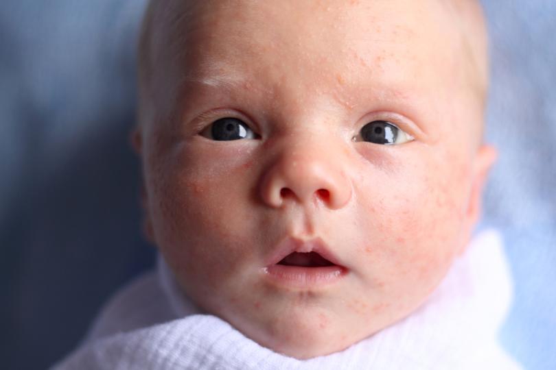 Бебешко акне - домашно лечение и грижа