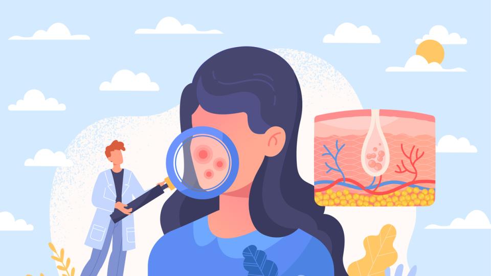 Акнето, този “верен приятел, който познаваш още от младежките си