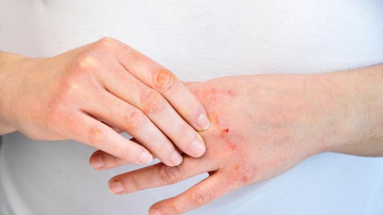6 съвета срещу суха кожа на ръцете през зимата