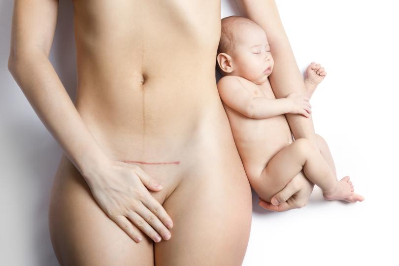 Как изглежда белегът от секцио след раждане