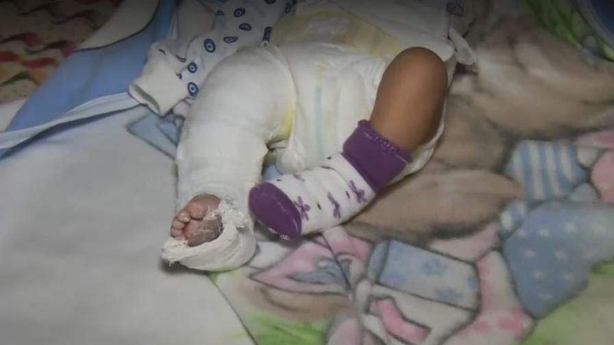 Приеха в болница новородено с жълтеница изписаха го със счупен крак