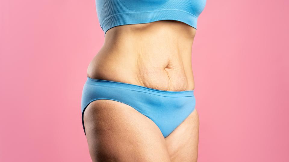 Загубата на тегло е значително постижение, но последиците като отпусната кожа могат