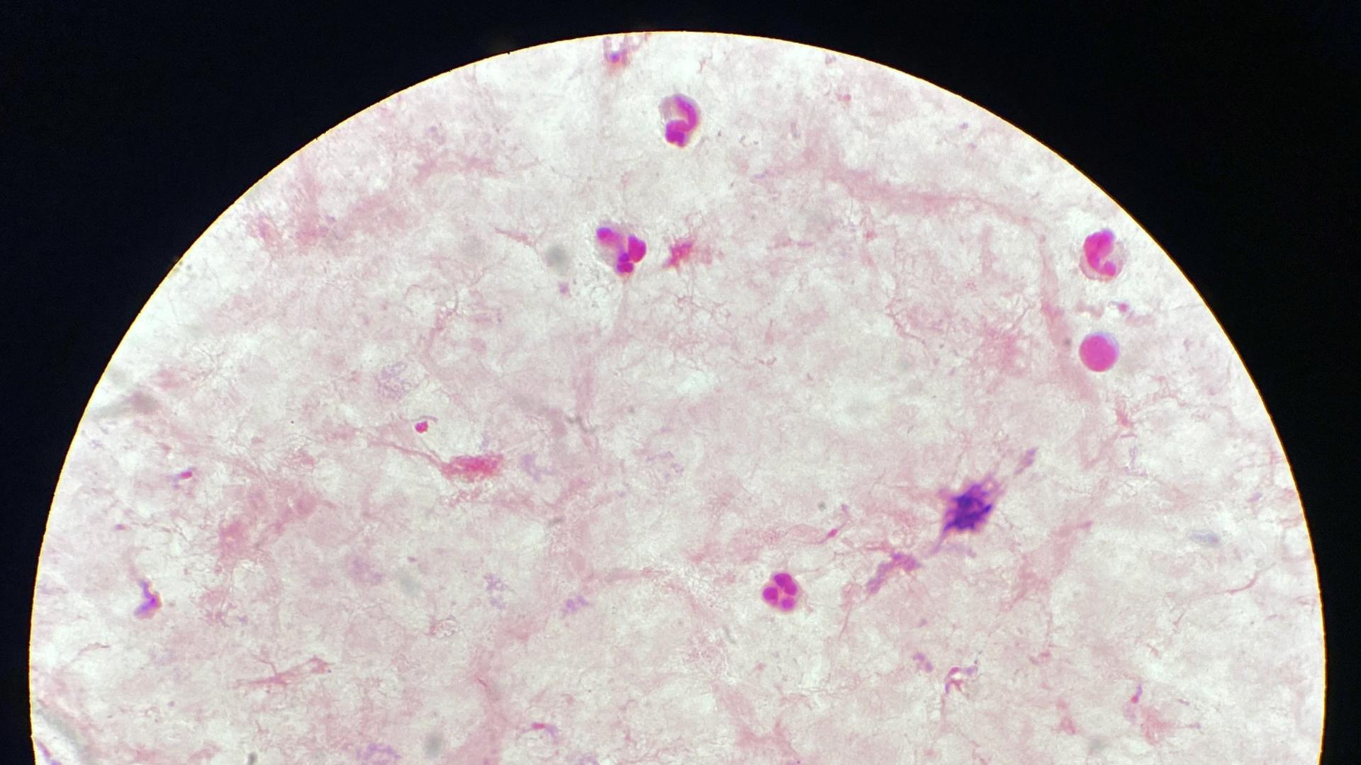 Смъртоносна болест настъпва в САЩ пренасяна от целуващи кръвопиещи буболечки