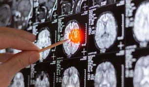 Нова надежда: Капки за нос помагат при лечение на мозъчни тумори