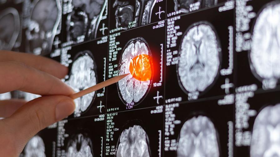 Нова надежда: Капки за нос помагат при лечение на мозъчни тумори