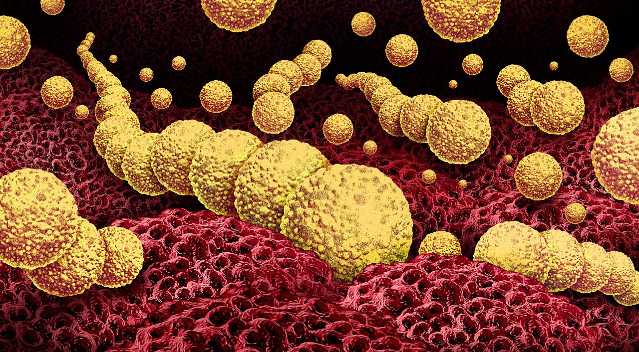 <p><strong>Некротизиращ фасциит</strong></p>

<p>Инфекция на дълбоките слоеве на кожата и подкожните тъкани, известна още като &bdquo;болестта ядяща плът&ldquo;. Най-често причинена от стрептокок от група А, наричан още &bdquo;ядящата плът бактерия&ldquo;, който навлиза в тялото през рани и отворени участъци на кожата.</p>