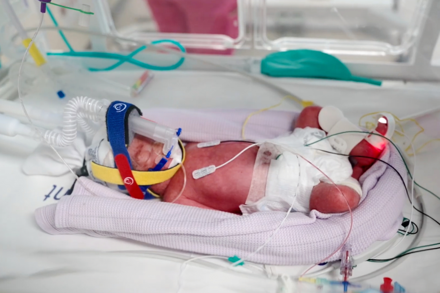 На снимката е недоносено новородено бебе в интензивно отделение за новородени (NICU)