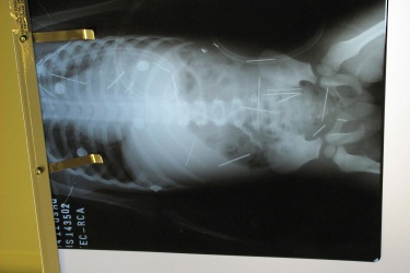 50 игли в тялото на 2-годишно бразилче