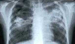 По 50 българи всяка година се разболяват от туберкулоза