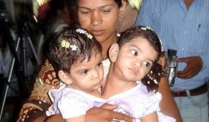 12 часа разделяха 11-месечни сиамски близначки